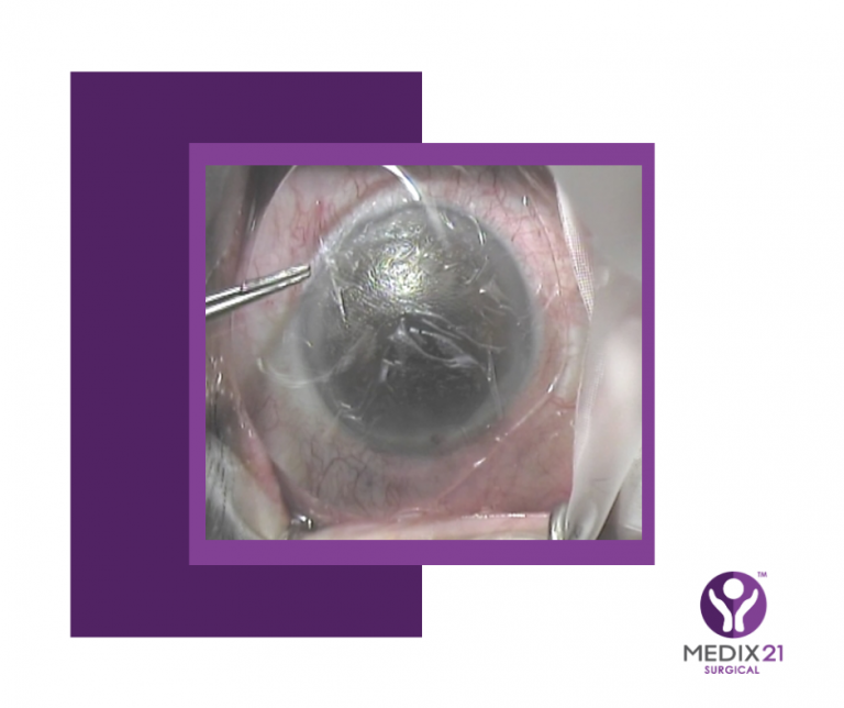 Amniotic Membrane for DED promising treatment Medix 21 Surgical Looking to the future